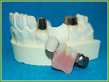 コーヌス・テレスコープ義歯
